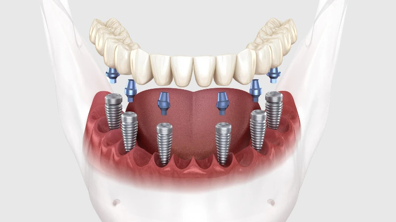 What is all-on-4 Dental Implant?