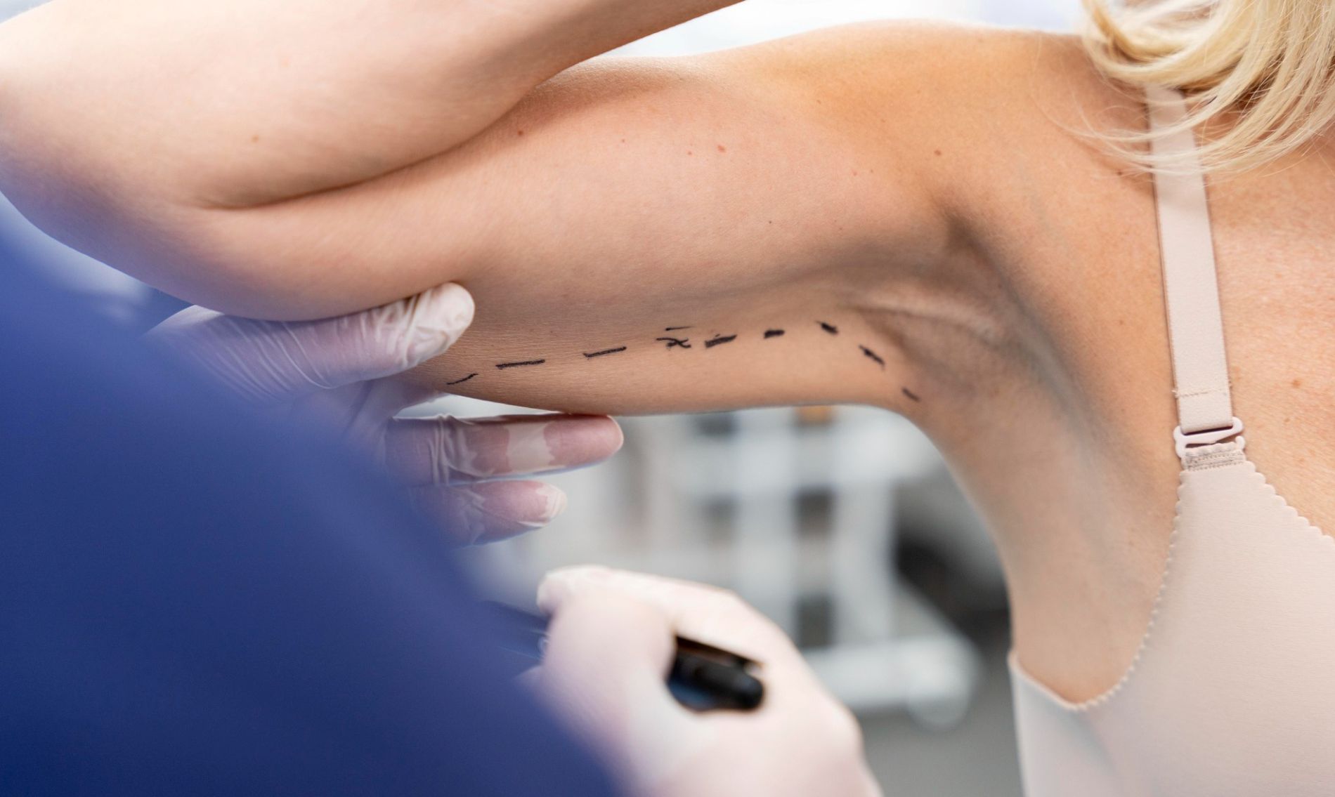 Arm Lift Steps, Advantages and Benefits