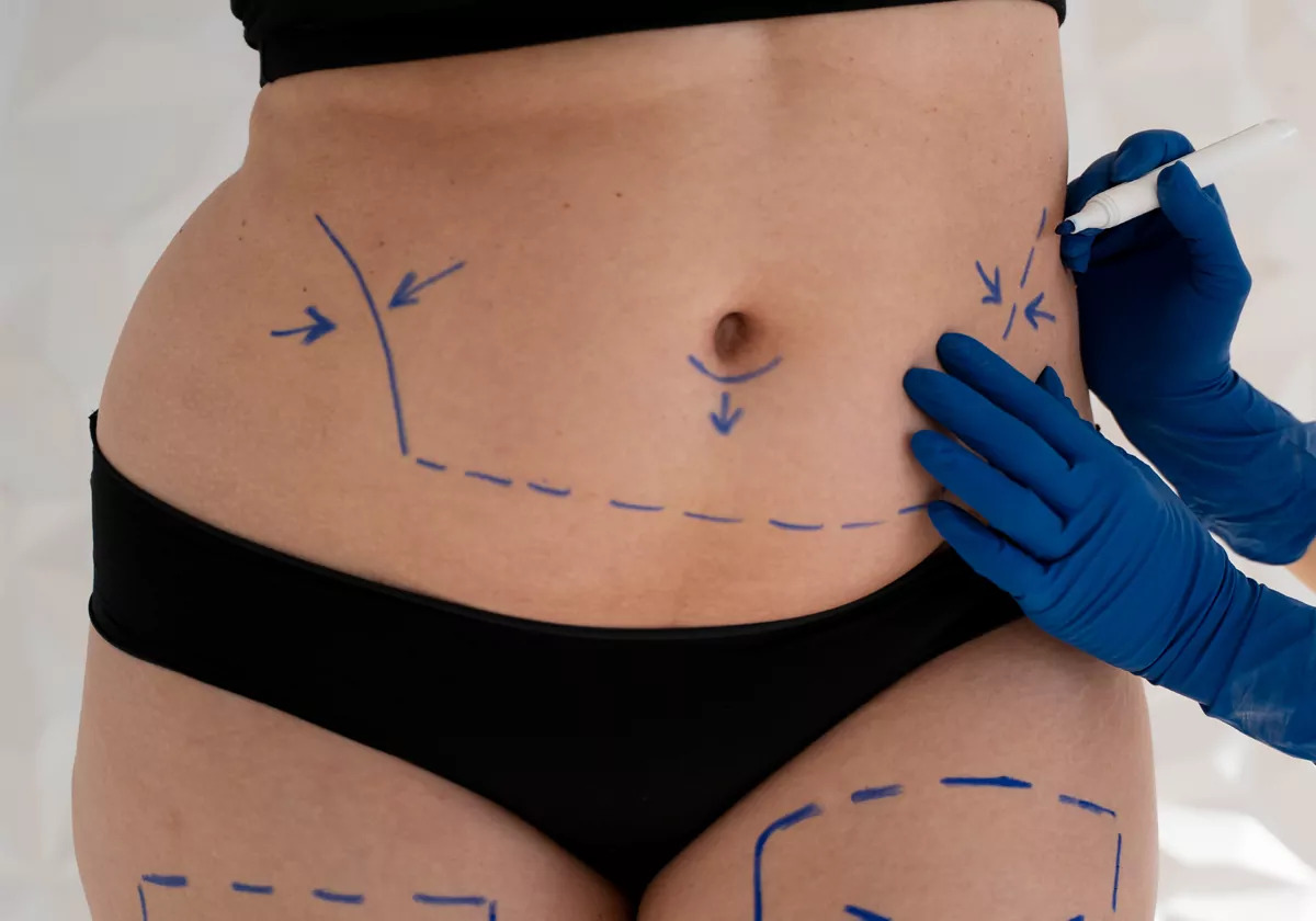 Liposuction Steps, Advantages and Benefits