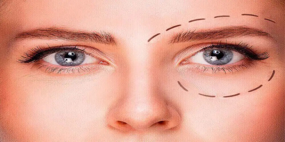 Eyelid Surgery Steps, Advantages and Benefits