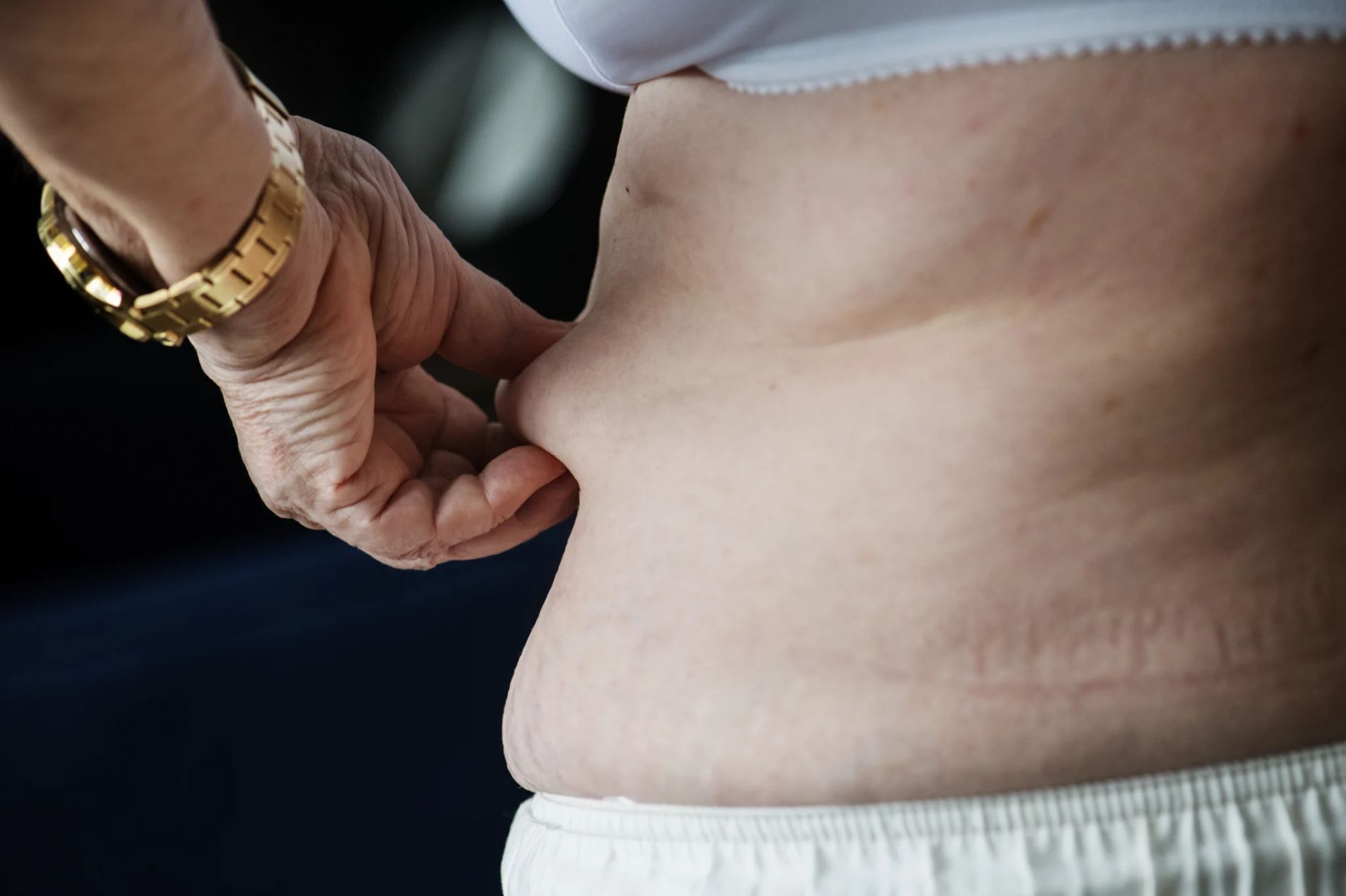 What are the important considerations for post gastric botox treatment? 