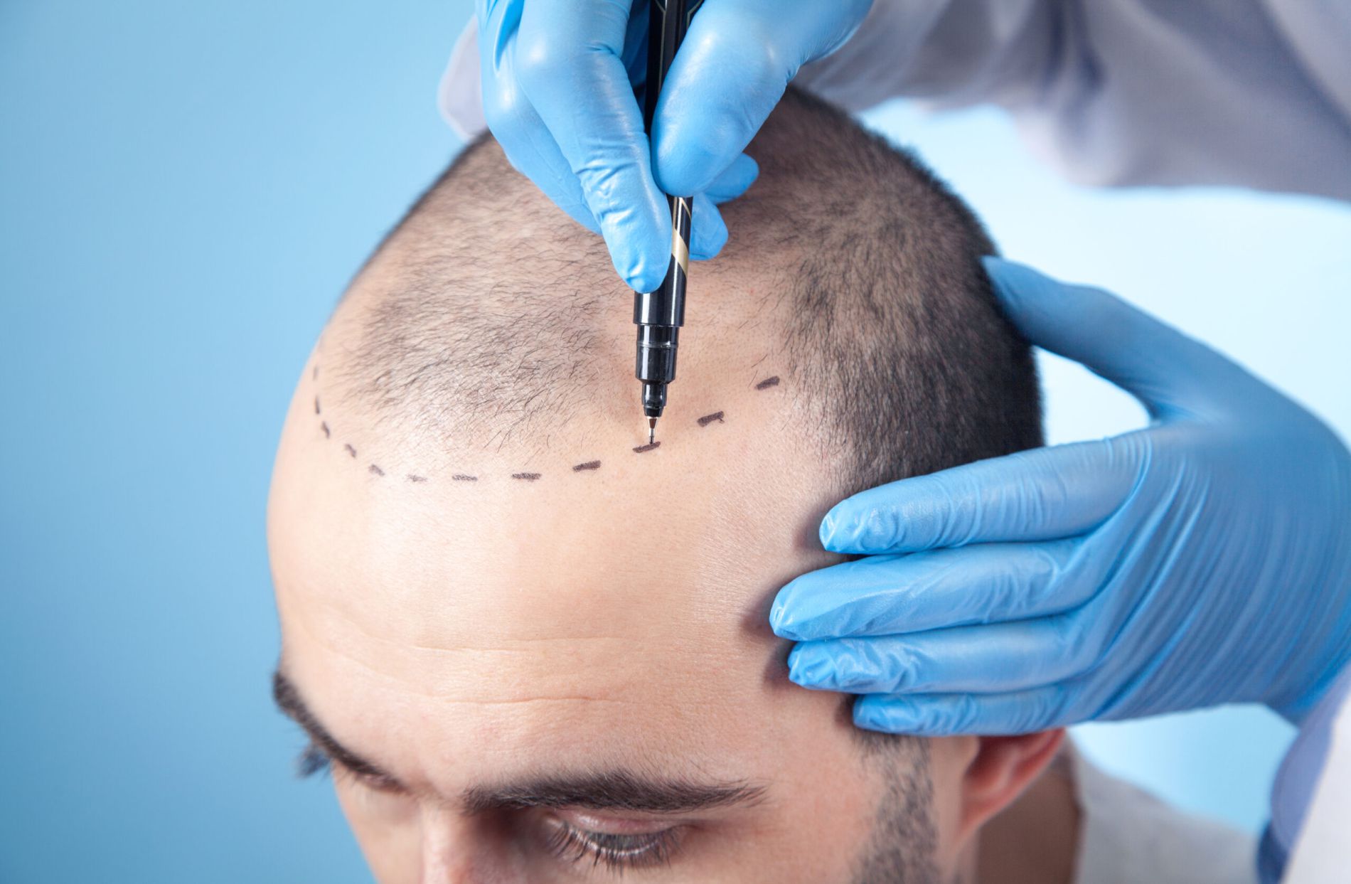 Who is eligible for hair transplantation?