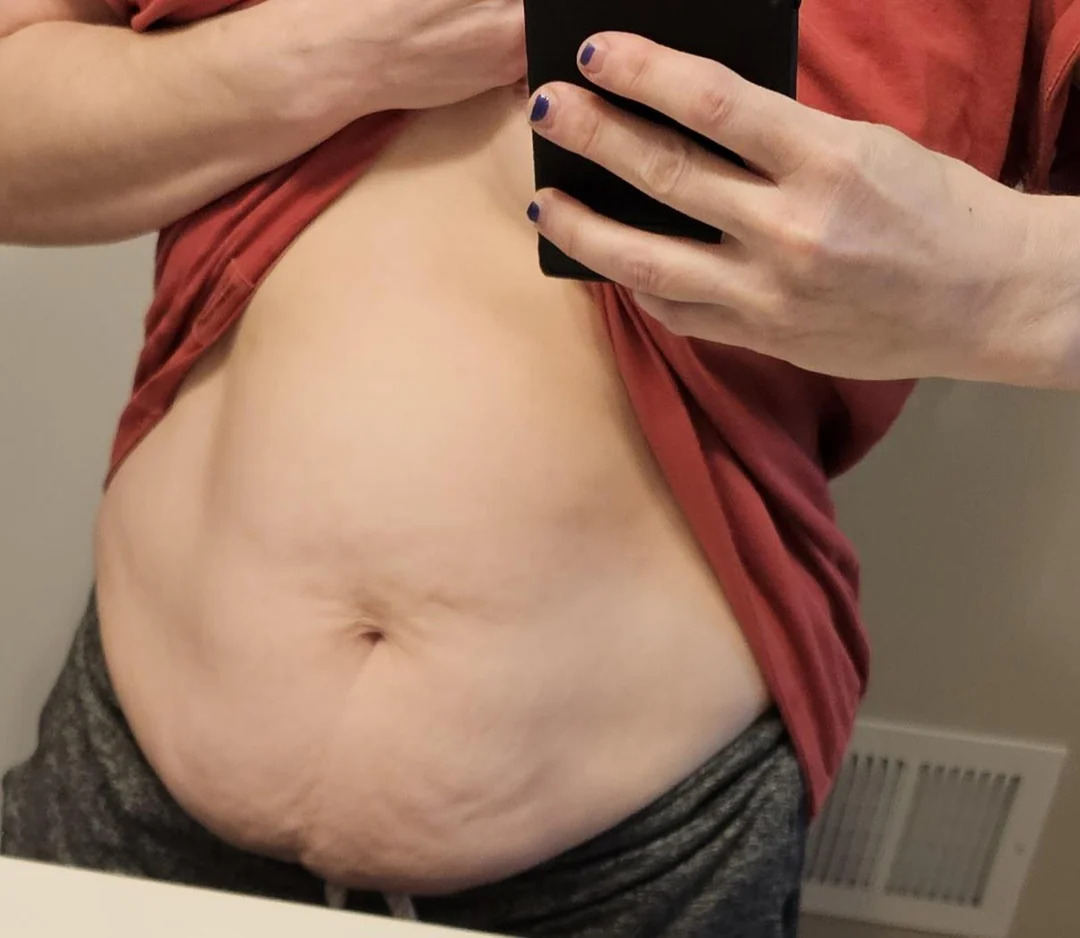 What is gastric balon and Who is eligible for gastric balon treatment?