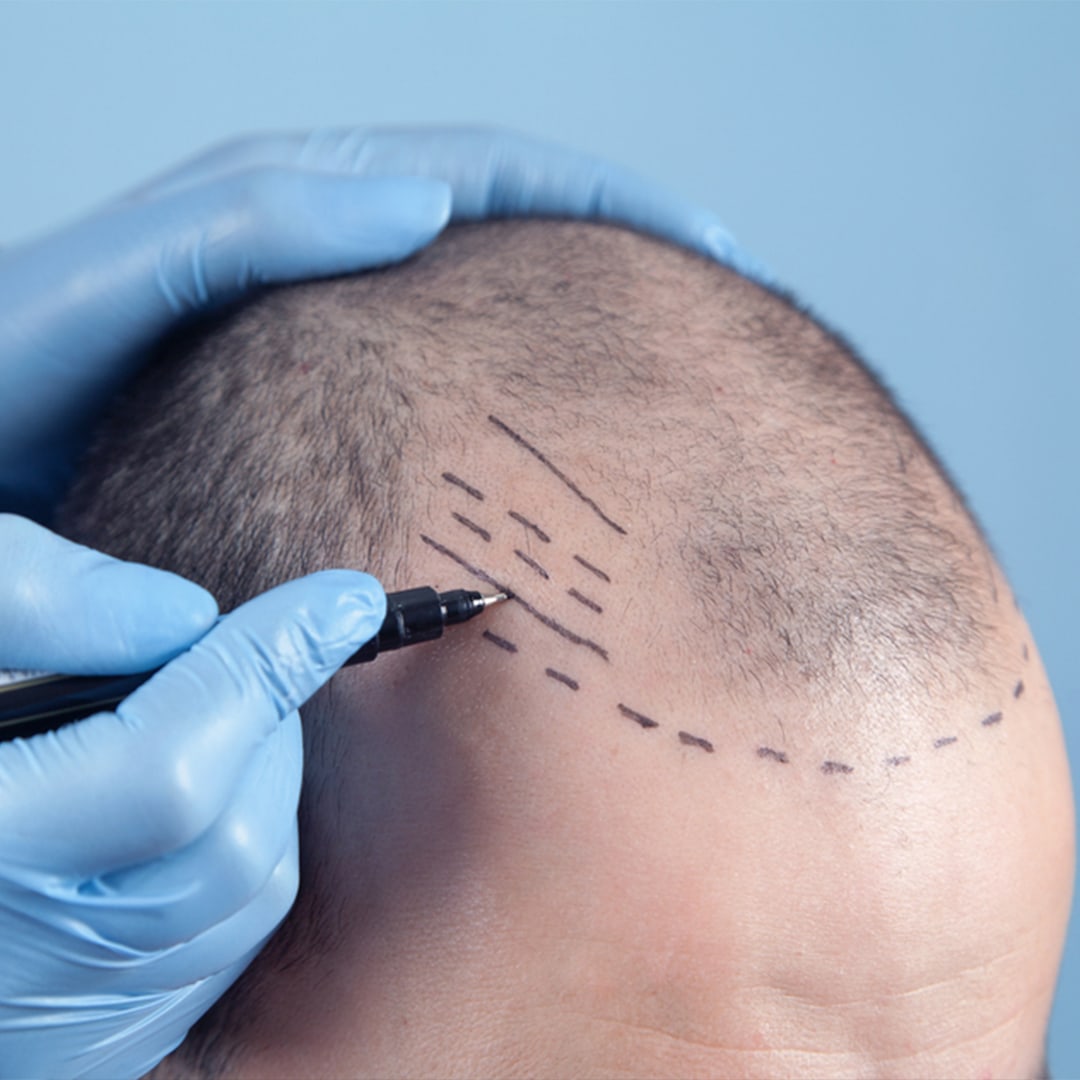 Hair Transplant img