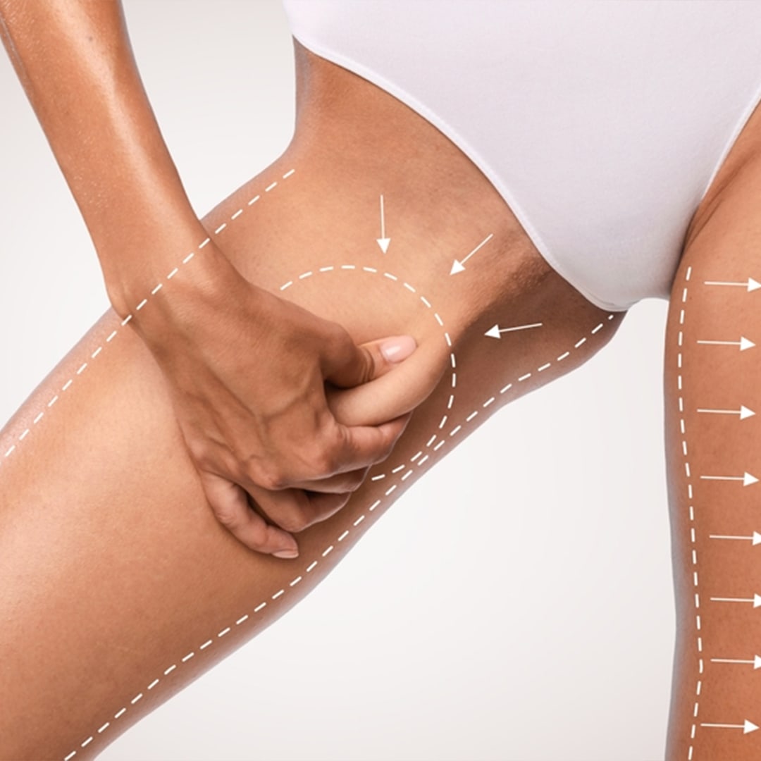 Thigh Lift img